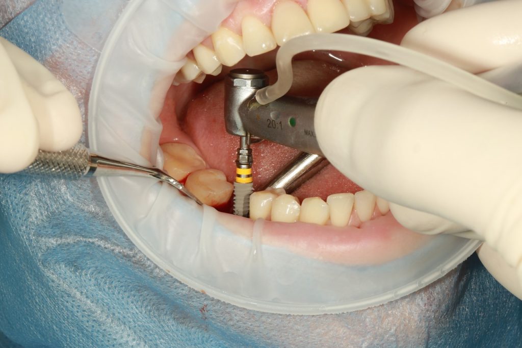 dental, implante, cirugía-3754769.jpg